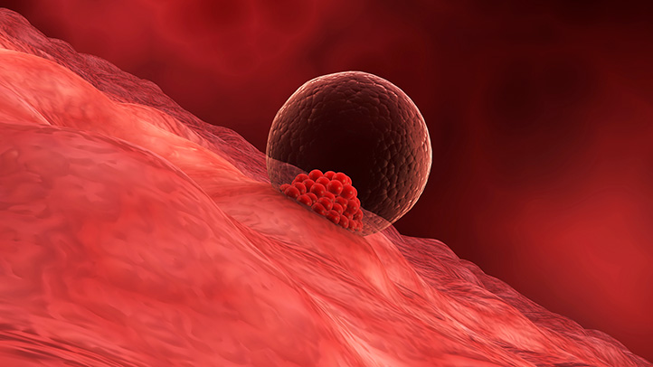 implantation, medical illustration of fertilized egg implanting in uterus